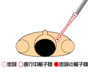 陽子線照射イメージ